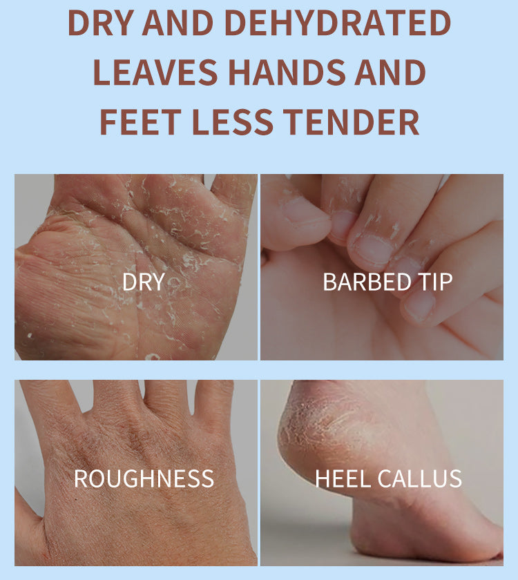 Comparison of dry, barbed tip, roughness, and heel callus on hands and feet with text about skin conditions. Estelin coconut oil hand cream 